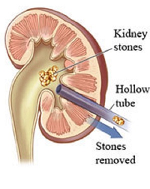 picture of kidney stones from soda